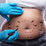 tummy tuck salt lake city