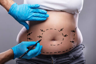 tummy tuck salt lake city